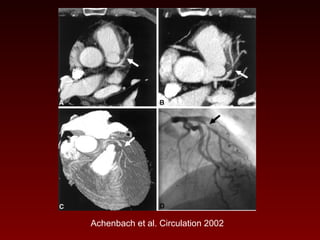 121 non invasive imaging of coronary arteries | PPT