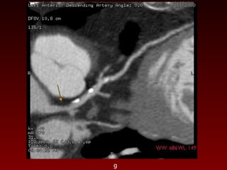 121 non invasive imaging of coronary arteries | PPT