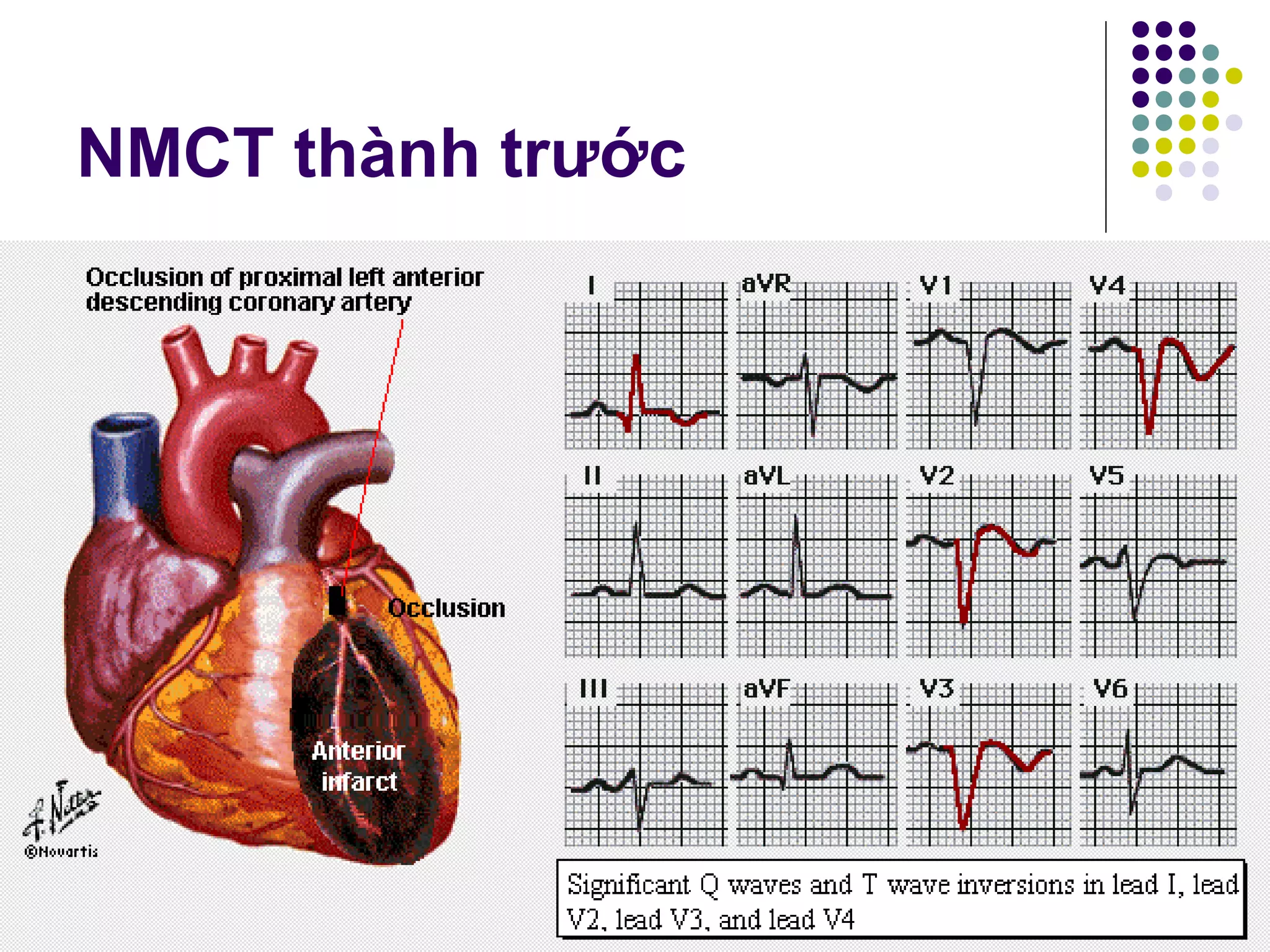 ECG TRONG NHỒI MÁU CƠ TIM | PPT
