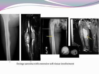 Ewings sarcoma with extensive soft tissue involvement
 