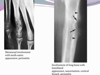 Metatarsal involvement
with moth-eaten
appearance, periostitis

                          Involvement of long bone with
                          lamellated
                          appearance, saucerisation, cortical
                          breach, periostitis
 