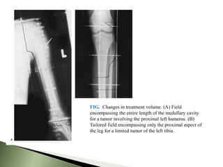 FIG. Changes in treatment volume. (A) Field
encompassing the entire length of the medullary cavity
for a tumor involving the proximal left humerus. (B)
Tailored field encompassing only the proximal aspect of
the leg for a limited tumor of the left tibia.
 