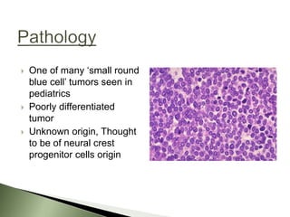  One of many ‘small round
blue cell’ tumors seen in
pediatrics
 Poorly differentiated
tumor
 Unknown origin, Thought
to be of neural crest
progenitor cells origin
 
