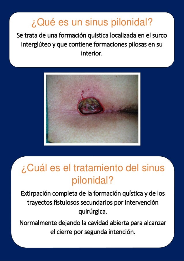 EWMA 2014 EP382 STANDARDIZED CURE FOR PILONIDAL SINUS