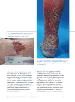 JOURNALOFWOUNDCAREVol 22. No 1. EWMA DocuMENt 2013 S 5
Fig 1.Woundmargincoveredbydriedexudate
andhyperkeratosiswhichmayimpairthe
physiologicalprocessofwoundhealing
Fig 2.Lowerlegwithwidelydisseminated,adherentcrusts
ofexudate,largeskinscales,hyperkeratosisanddebris,
whichmayimpairthephysiologicalprocessofwoundhealing.
Nodefinedulcer.
probability to achieve clinical benefi ts such as 
increased quality of life of the patient, fewer 
odours, improved microcirculation, normalised 
biochemistry including normalising the matrix 
metalloproteinase (MMP) balance, decreased 
access of moisture and stimulated wound edges. A 
global approach to debridement offers advantages 
with regards to the possibility to clearly defi ne 
wound phase targets for debridement and review 
whether these targets have been achieved. 
Primary targets for debridement have been 
summarised in Table 1.
Indicationsfordebridement
As debridement represents a central step in the 
management of wounds it can be applied to all kinds 
of wounds, irrespective of their diagnoses and origin. 
The question arises with regards to the indication 
for debridement and timing of the procedure. A 
clear indication can be generated via the diagnosis 
of different kinds of tissue types and bioburden 
which cover the wound bed, the state of the wound 
edges and the peri-wound skin. A tissue type related 
defi nition of debridement allows the clinicians to 
defi ne the right time point for debridement and to 
 