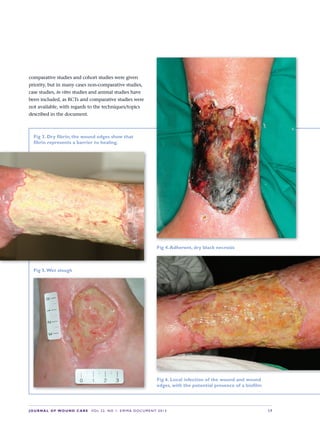 JOURNALOFWOUNDCAREVol 22. No 1. EWMA DocuMENt 2013 S 7
Fig 3.Dryfibrin;thewoundedgesshowthat
fibrinrepresentsabarriertohealing.
Fig 4.Adherent,dryblacknecrosis
Fig 5.Wetslough
Fig 6.Localinfectionofthewoundandwound
edges,withthepotentialpresenceofabiofilm
comparative studies and cohort studies were given 
priority, but in many cases non-comparative studies, 
case studies, in vitro studies and animal studies have 
been included, as RCTs and comparative studies were 
not available, with regards to the techniques/topics 
described in the document.
 