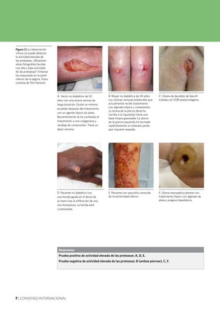 7 | CONSENSO INTERNACIONAL
Respuestas
Prueba positiva de actividad elevada de las proteasas: A, D, E.
Prueba negativa de actividad elevada de las proteasas: B (ambas piernas), C, F.
Figura 2 | La observación
clínica no puede detectar
la actividad elevada de
las proteasas. ¿Muestran
estas fotografías heridas
con alta o baja actividad
de las proteasas? (Véanse
las respuestas en la parte
inferior de la página. Fotos
cortesía de Tom Serena)
B: Mujer no diabética de 40 años
con úlceras venosas bilaterales que
actualmente recibe tratamiento
con alginato tópico y compresión.
La úlcera de la pierna derecha
(arriba a la izquierda) tiene una
base limpia granulada. La úlcera
de la pierna izquierda ha formado
repetidamente un esfacelo pardo
que requiere raspado.
C: Úlcera de decúbito de fase III
tratada con COR-plata/colágeno.
D: Paciente no diabético con
una herida aguda en el dorso de
la mano tras la infiltración de una
vía intravenosa. La herida está
cicatrizando.
E: Paciente con vasculitis conocida
de la extremidad inferior.
F: Úlcera neuropática plantar con
tratamiento tópico con alginato de
plata y oxígeno hiperbárico.
A: Varón no diabético de 52
años con una úlcera venosa de
larga duración. Existe un mínimo
exudado después del tratamiento
con un agente tópico de plata.
Recientemente se ha cambiado el
tratamiento a una colagenasa y
vendaje de compresión. Tiene un
dolor mínimo.
 