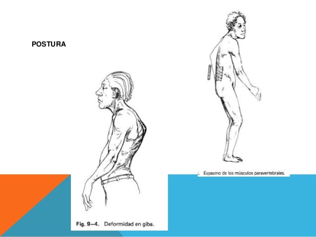 Exploración física de la columna
