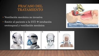 FRACASO DEL
TRATAMIENTO
• Ventilación mecánica no invasiva
• Emitir al paciente a la UCI  intubación
orotraqueal y ventilación mecánica
 
