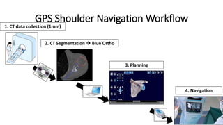 GPS Shoulder Navigation Workflow
1. CT data collection (1mm)
2. CT Segmentation  Blue Ortho
3. Planning
4. Navigation
 