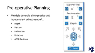 Pre-operative Planning
• Multiple controls allow precise and
independent adjustment of…
• Depth
• Version
• Inclination
• Rotation
• AP/SI Position
 