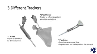 “P” as Probe
- To register anatomical data
- To go forward and backward into the protocol
“T” as Tool
Tracker to reference
the drill instrument
“G” as Glenoid
Tracker to reference patient
glenoid/scapula bone
3 Different Trackers
 
