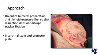 Approach
• Do entire humeral preparation
and glenoid exposure first so that
dissection does not disrupt
tracker fixation
• Insert trial stem and protector
plate
 