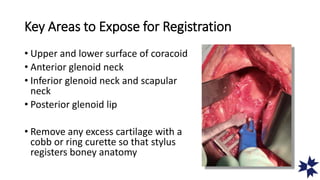 Key Areas to Expose for Registration
• Upper and lower surface of coracoid
• Anterior glenoid neck
• Inferior glenoid neck and scapular
neck
• Posterior glenoid lip
• Remove any excess cartilage with a
cobb or ring curette so that stylus
registers boney anatomy
 