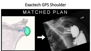 Exactech GPS Shoulder
 