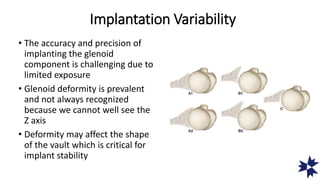 Implantation Variability
• The accuracy and precision of
implanting the glenoid
component is challenging due to
limited exposure
• Glenoid deformity is prevalent
and not always recognized
because we cannot well see the
Z axis
• Deformity may affect the shape
of the vault which is critical for
implant stability
 