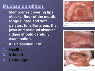 Mucosa condition:
Membranes covering lips,
cheeks, floor of the mouth,
tongue, hard and soft
palates, tonsillar areas, the
jaws and residual alveolar
ridges should carefully
examination.
It is classified into:
1. Healthy
2. Irritated
3. Pathologic.

 