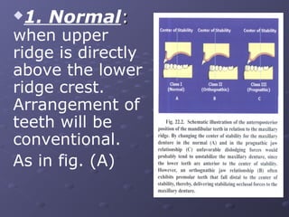 1. Normal:



when upper
ridge is directly
above the lower
ridge crest.
Arrangement of
teeth will be
conventional.
As in fig. (A)

 
