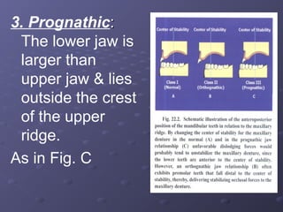 3. Prognathic:
The lower jaw is
larger than
upper jaw & lies
outside the crest
of the upper
ridge.
As in Fig. C

 