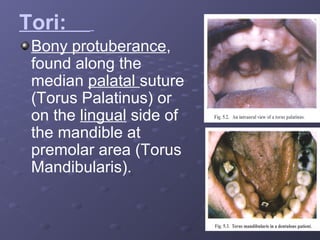 Tori:
Bony protuberance,
found along the
median palatal suture
(Torus Palatinus) or
on the lingual side of
the mandible at
premolar area (Torus
Mandibularis).

 