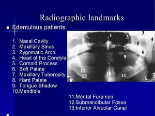 Radiographic landmarks


Edentulous patients
1. Nasal Cavity
2. Maxillary Sinus
3. Zygomatic Arch
4. Head of the Condyle
5. Cornoid Process
6. Soft Palate
7. Maxillary Tuberosity
8. Hard Palate
9. Tongue Shadow
10.Mandible

11.Mental Foramen
12.Submandibular Fossa
13.Inferior Alveolar Canal

 