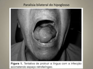                                                                             ramo vestibular: utrículo, sáculo                                                                            e os três canais semicirculares –                                                                             labirinto membranoso (endolinfa).Ramo coclear: ossículos auditivos(martelo, bigorna, e estribo)*vestíbulo, a cóclea e os canais semicirculares formam o labirinto ósseo –perilinfa.ANATOMIA DO OUVIDO INTERNO