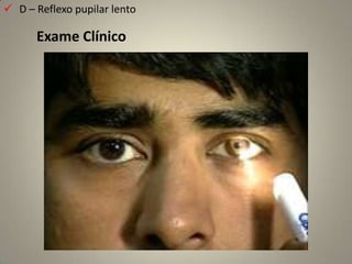 Intra-orbital (cerca de 25 mm)