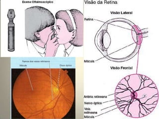 Intracanalicular (cerca de 9 mm)