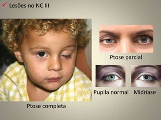  Defeitos altitudinais