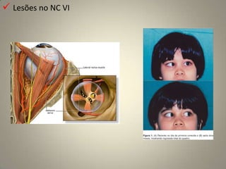 B – Comprometimento da visão de cores