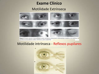 C – Diminuição da acuidade visual