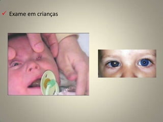 D – Reflexo pupilar lentoLesões do NC II