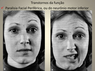  *NC V é o maior nervo craniano