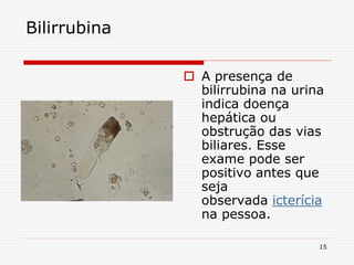 15
Bilirrubina
 A presença de
bilirrubina na urina
indica doença
hepática ou
obstrução das vias
biliares. Esse
exame pode ser
positivo antes que
seja
observada icterícia
na pessoa.
 
