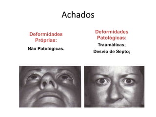 Achados
Deformidades
Próprias:
Não Patológicas.
Deformidades
Patológicas:
Traumáticas;
Desvio de Septo;
 