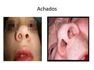 Achados
 