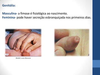 Genitália:
Masculina- a fimose é fisiológica ao nascimento.
Feminina- pode haver secreção esbranquiçada nos primeiros dias.
 