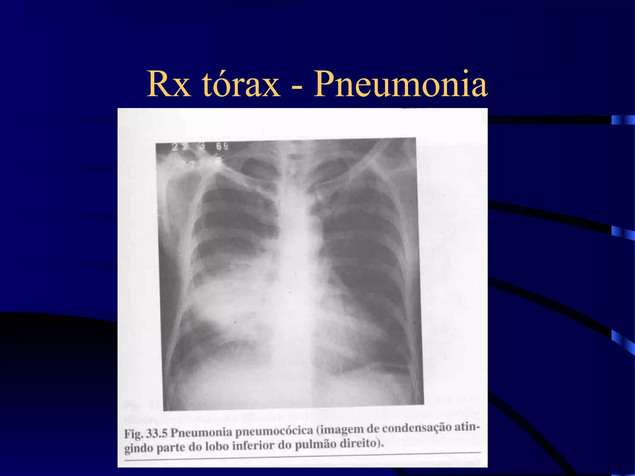 Rx tórax - Pneumonia
 
