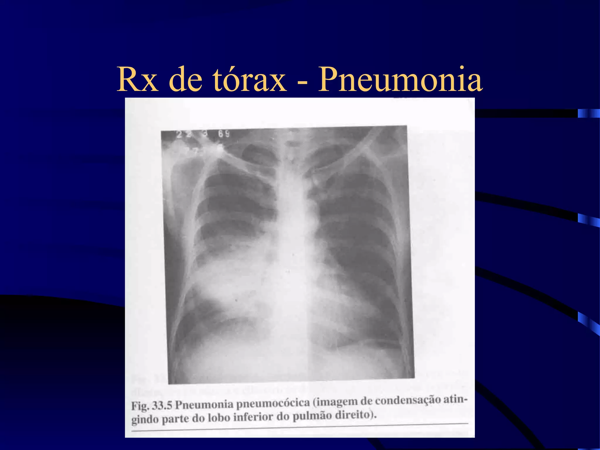 Rx de tórax - Pneumonia
 