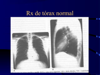 Rx de tórax normal
 