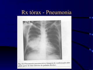 Rx tórax - Pneumonia
 