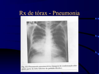 Rx de tórax - Pneumonia
 