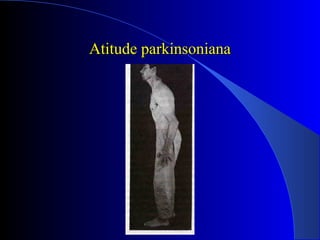 Atitude parkinsonianaAtitude parkinsoniana
 