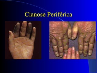 Cianose PeriféricaCianose Periférica
 