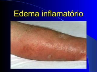 Edema inflamatórioEdema inflamatório
 