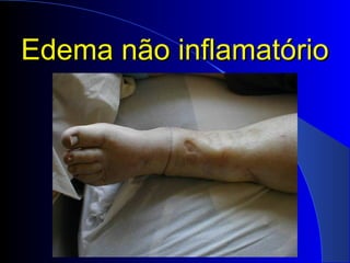 Edema não inflamatórioEdema não inflamatório
 