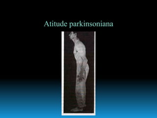 Atitude parkinsoniana
 