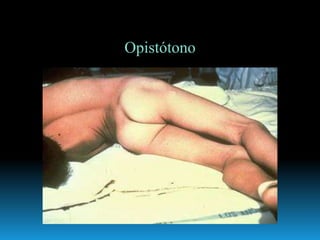 Opistótono
 