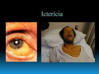 Icterícia
 