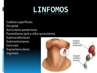 LINFOMOS
Cadeias superfíciais
Occipital
Auriculares posteriores
Parotidianos (pré e infra-auriculares)
Submandibulares
Submentonianos
Cervicais
Supraclaviculares
Inguinais
 